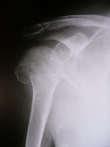 proximal humerus fractures