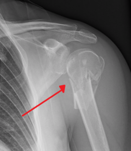 Proximal Humerus Fracture