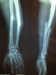 bone fracture