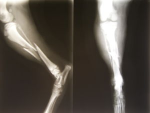 comminuted fracture