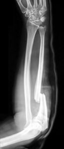 forearm fracture