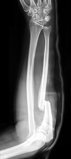 forearm fracture
