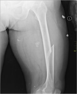 long bone fractures