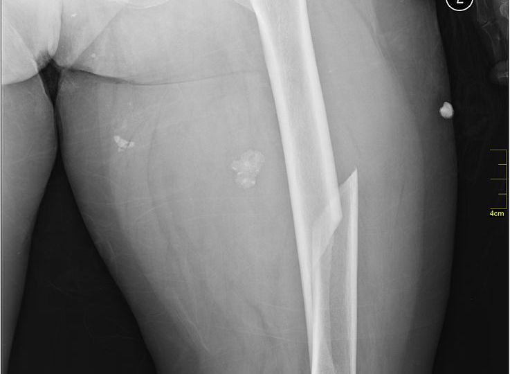 long bone fractures