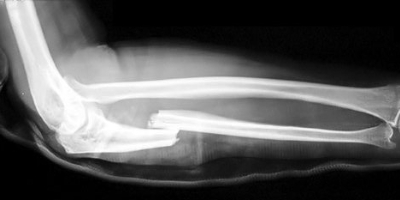 forearm fracture