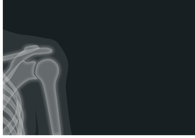 broken shoulder proximal humerus fracture